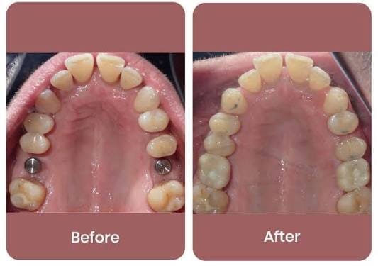 Happy Patient - Teeth Cleaning Uttam Nagar New Delhi